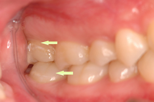 歯の表面の白い点について 豆知識ブログ 鹿児島市の歯科 さこだ歯科 医療法人篤志会